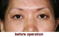 plastic-surgery-blepharoplasty